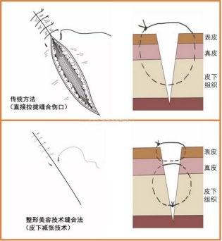 论腹壁整形中的减张缝合法!