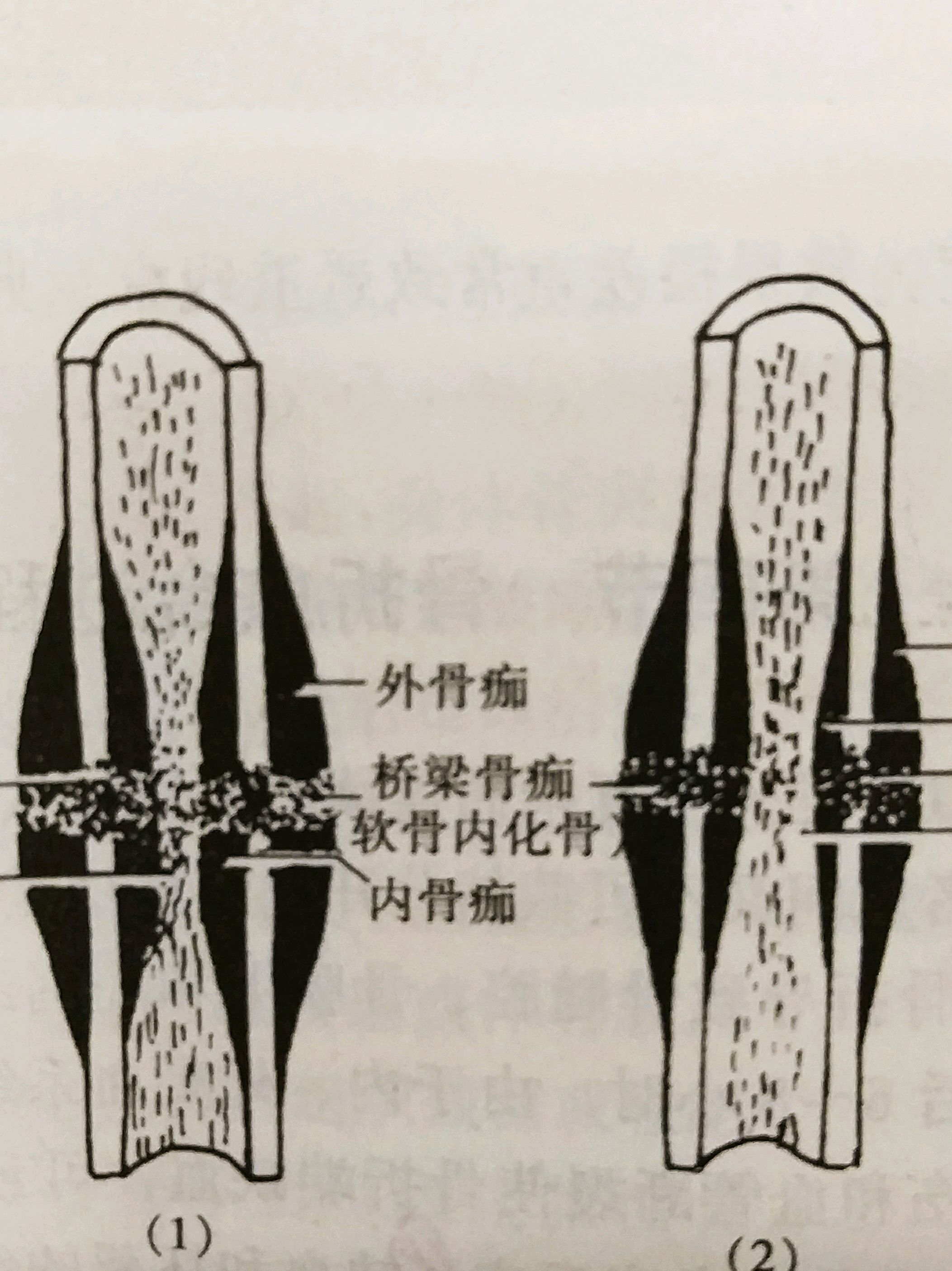 骨头愈合过程示意图图片