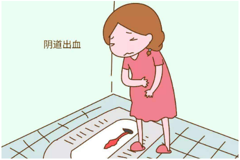 往往会被忽视,但如果持续性不规律出血,可能是由体内宫颈癌变引起