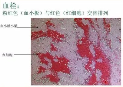 血小板增多要谨防血栓病情！谢别录工作室整理_胡桂生_主治医师_爱问健康