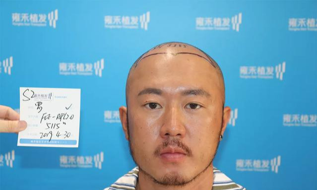 如何判断脱发的类型?(附带额角、秃顶改善)_刘长春_主任医师_爱问健康