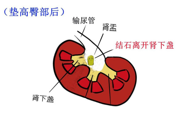 肾下极在哪图片