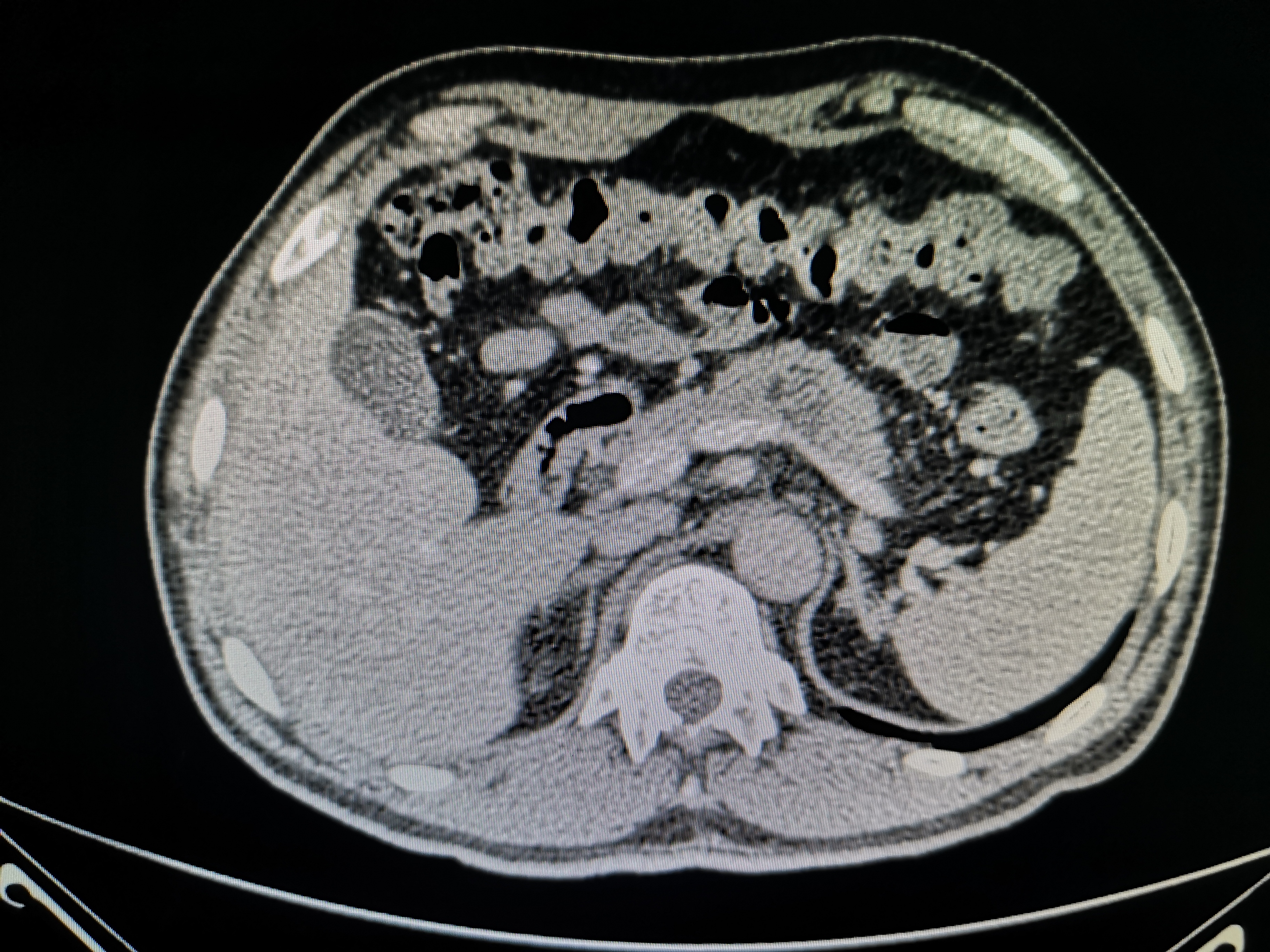 炎症相关胰腺肿瘤外科治疗1例
