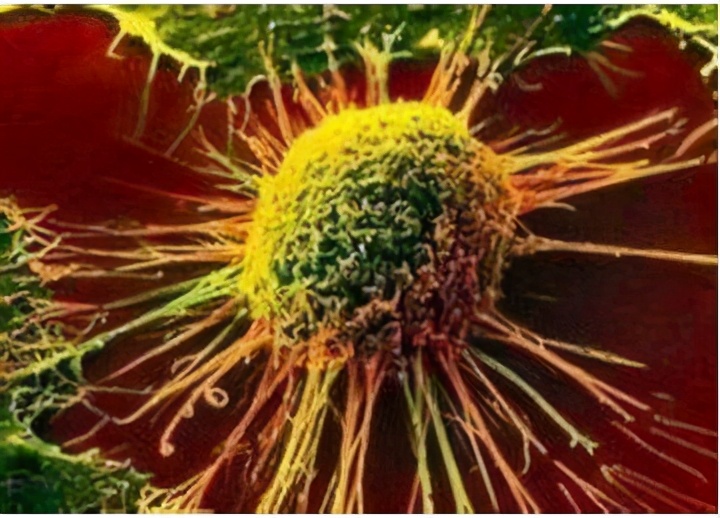 什么是毛细胞白血病?有哪些特点和症状?