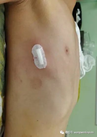 父子同患鸡胸今天上午同期手术wenlin手术wenli