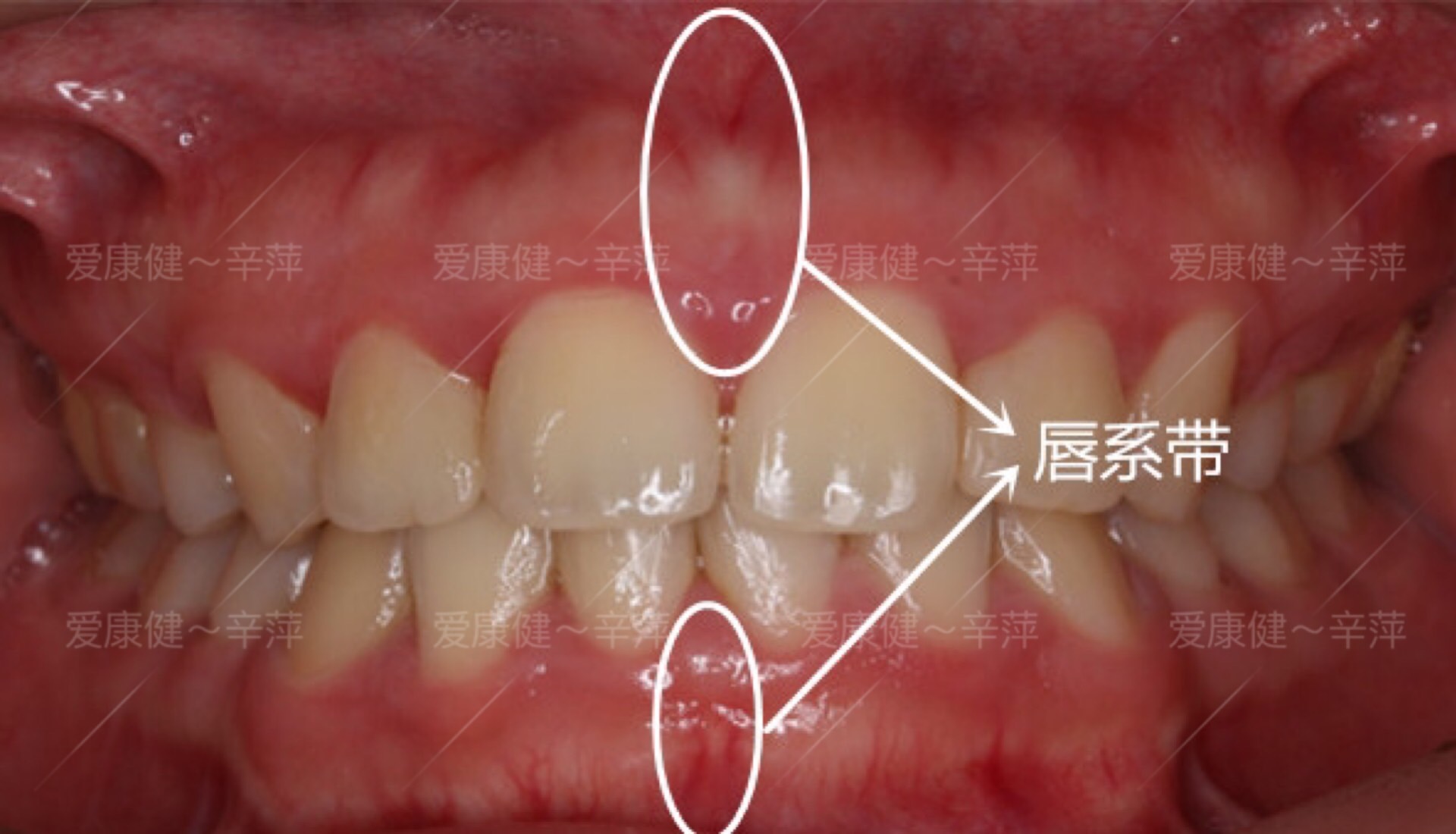 孩子门牙缝太大,原来是唇系带惹的祸!