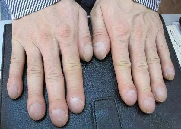 有些人的手会出现鼓槌的情况,通常手指的小节部位看起来是粗大圆钝,乍