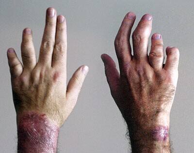 什么是窄谱紫外线治疗皮肤科普：窄谱中波紫外线使用须知_https://www.jmylbn.com_新闻资讯_第2张