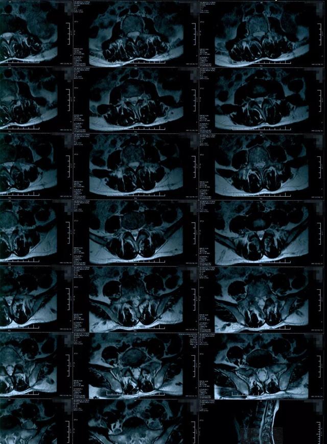 病例点评多发性神经纤维瘤