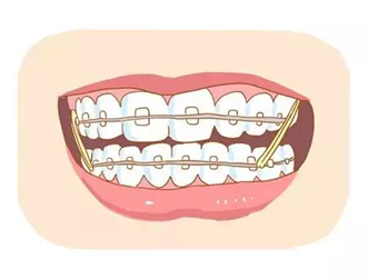 ①正畸橡皮圈的作用