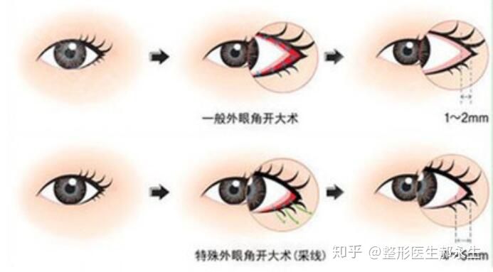 外眼角开大价格：医美行业的最新趋势