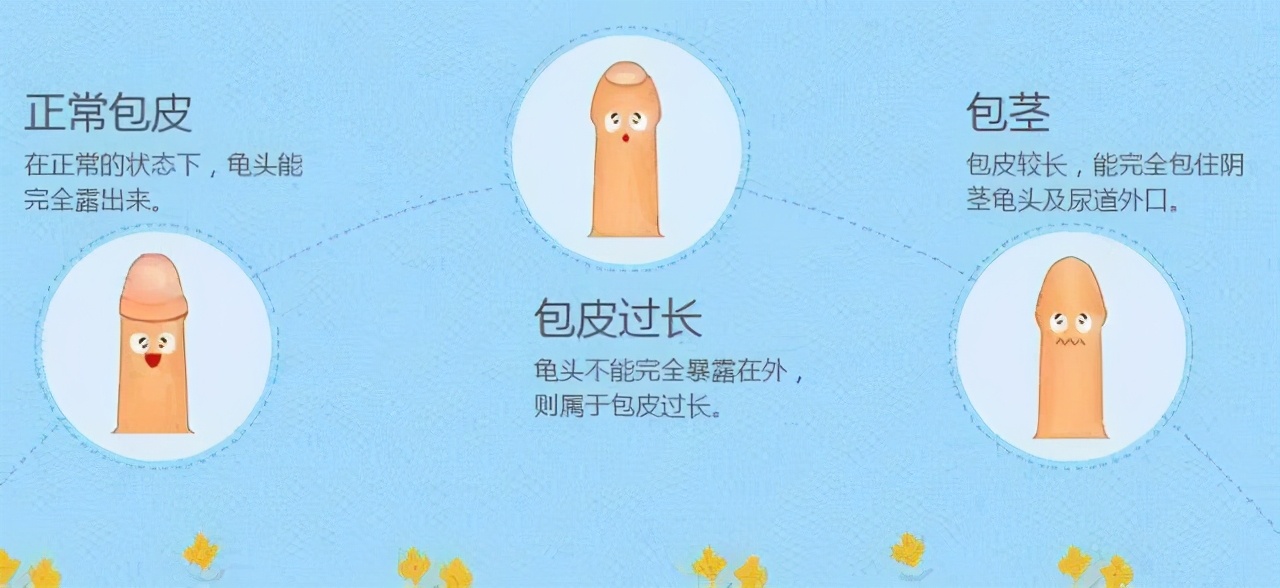包茎可以说是包皮过长的升级版,包皮将整个阴茎头都给覆盖了,而且由于