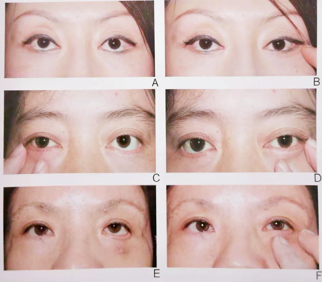 眼睑退缩的定义、病因和分类_邢新_主任医师_爱问健康
