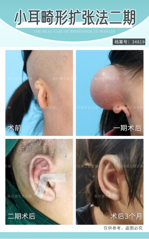 如何判断哪种耳再造方法更适合自己?_余文林_副主任医师_爱问健康