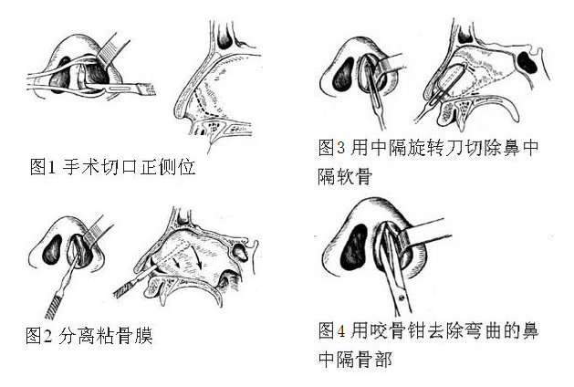 鼻中隔三线减张矫正术图片