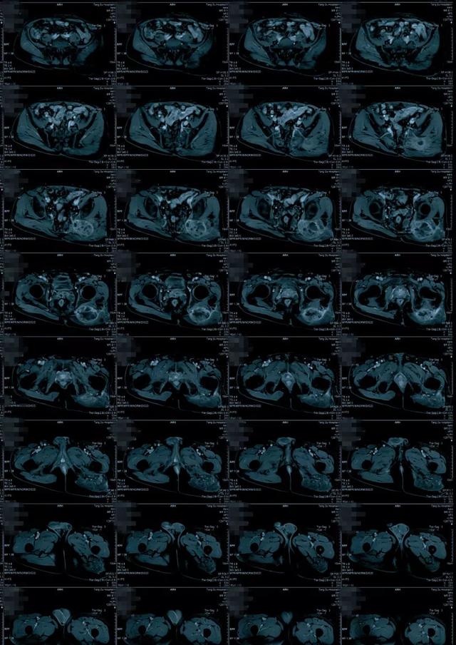 病例点评多发性神经纤维瘤