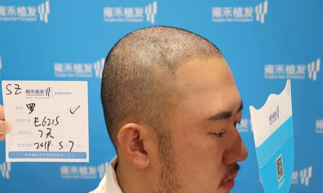 如何判断脱发的类型?(附带额角、秃顶改善)_刘长春_主任医师_爱问健康