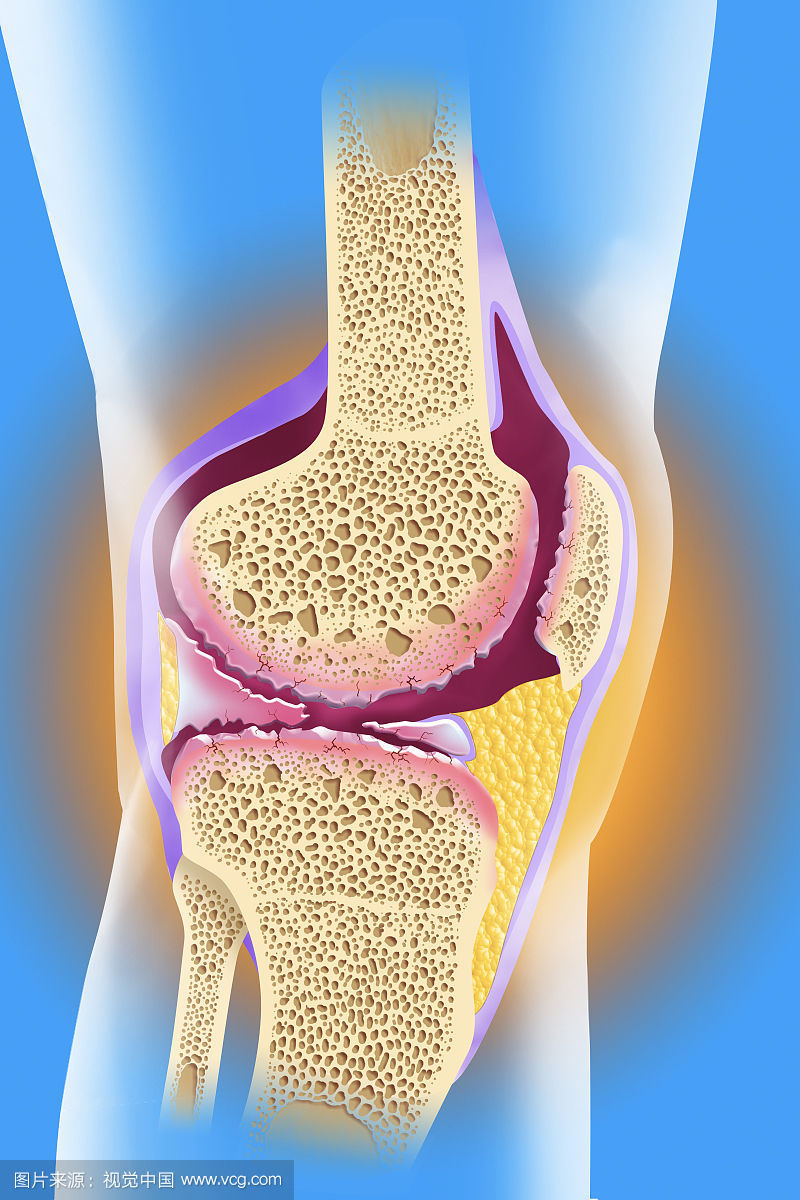 大妈患上了关节炎又得了骨刺和关节缝隙变窄可把她给吓坏了