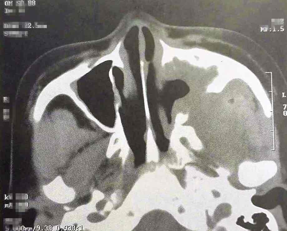 图文解说：鼻窦真菌感染的CT诊断_张旭戈_副主任医师_爱问健康