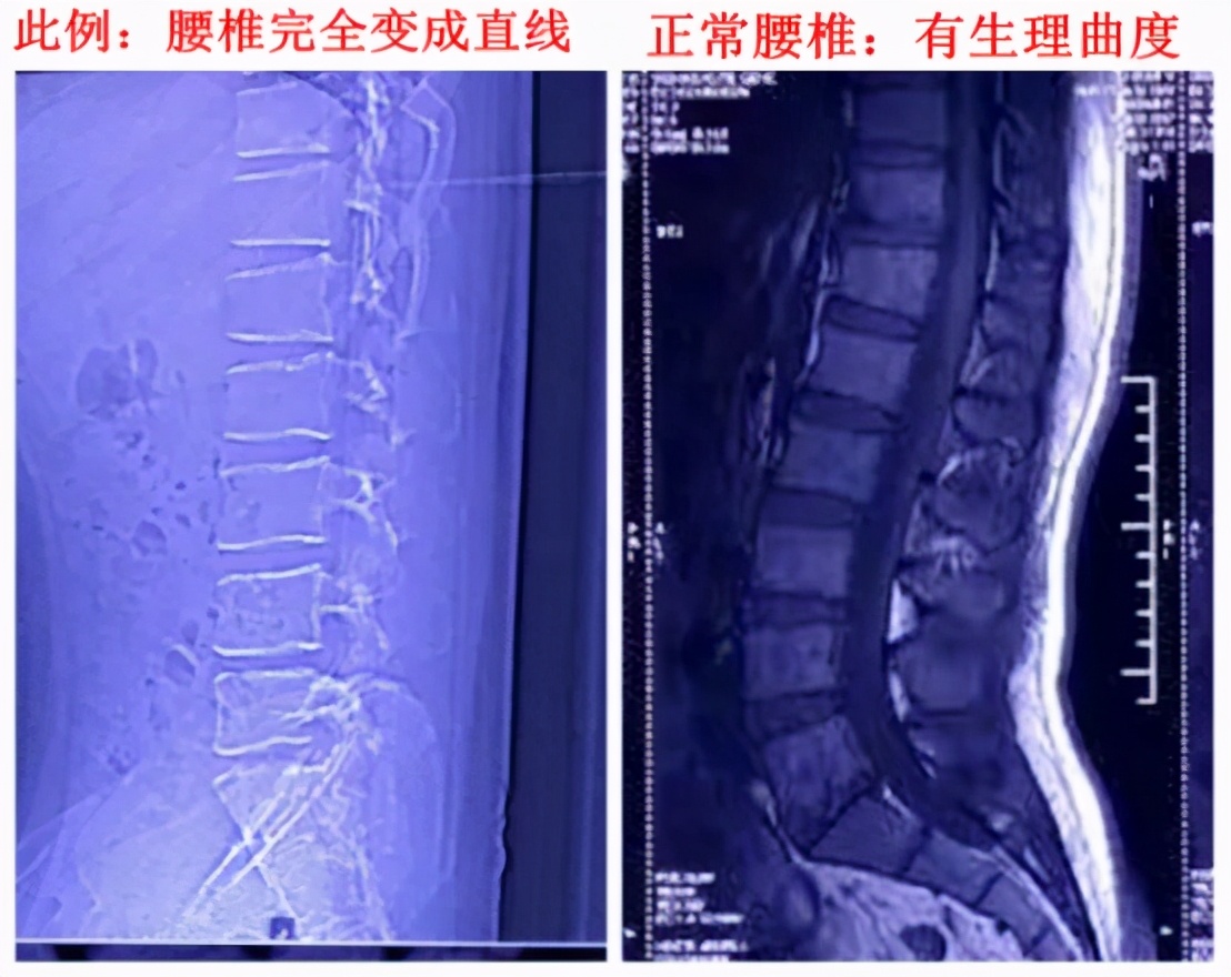 挺直腰杆不一定是好事!腰椎生理曲度变直,该怎么办?