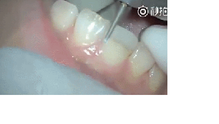做烤瓷牙全过程，看看牙齿是怎么被磨小的！