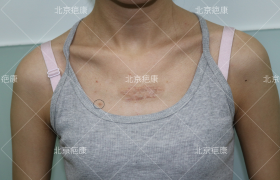病例分析：天津东女士前胸后肩瘢痕疙瘩