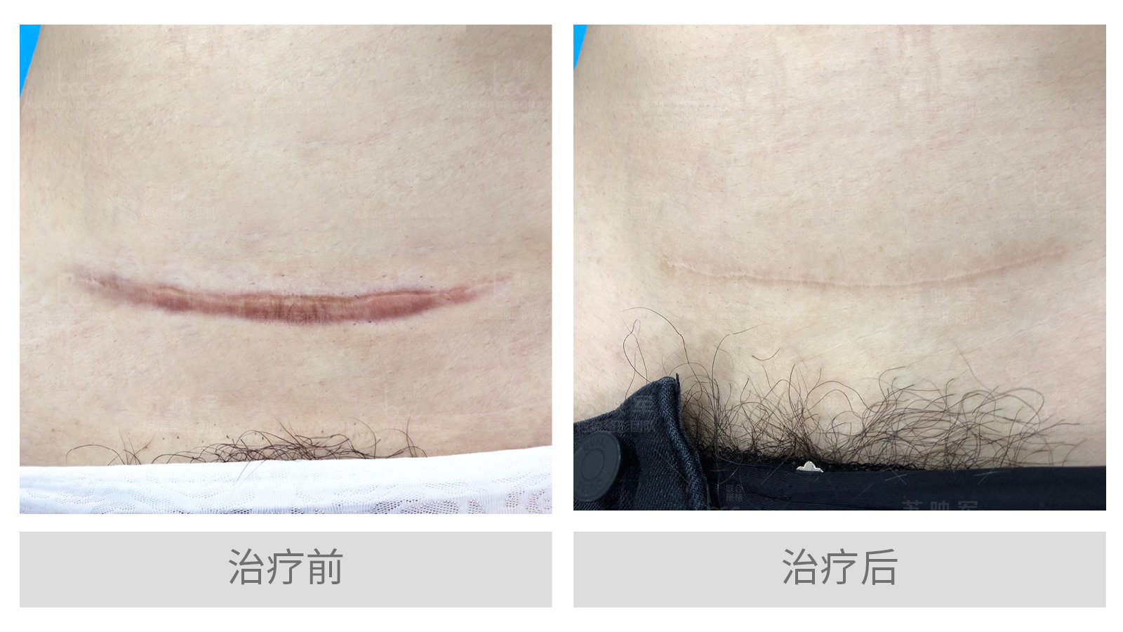 疤痕增生如何消除?_苏映军__爱问健康