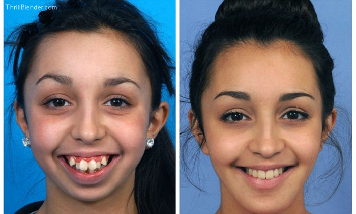 美版ab牙齿外翻被笑称魔兽妹没想到矫正6年后美到飞起