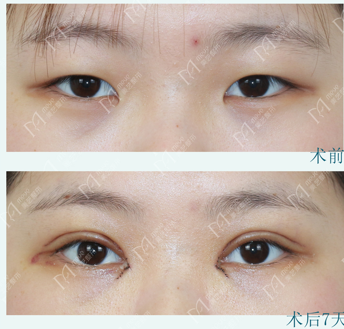 肿眼泡的眼型双眼皮手术设计理念