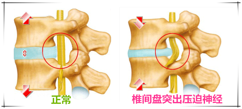 腰椎间盘到底是什么样的盘?