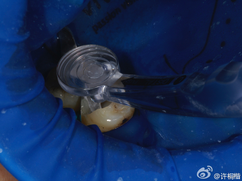 为什么牙医不用开口器初试Ivoclar大块充填（bulk fill）树脂_https://www.jmylbn.com_新闻资讯_第3张