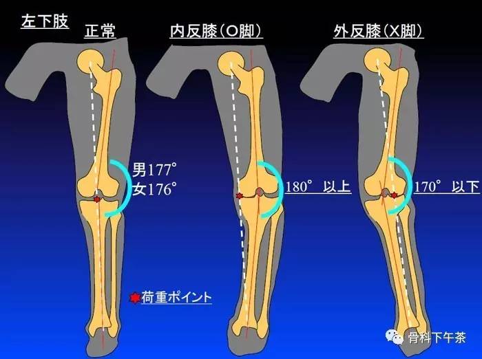 【科普】一类膝关节骨关节炎的治疗