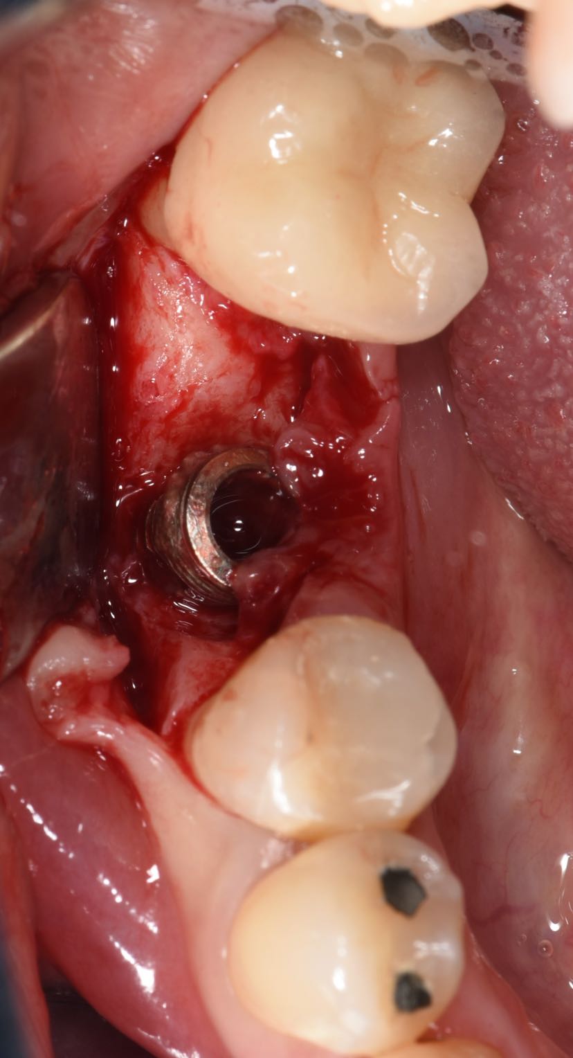 拆除原来的种植牙冠口内照片可见颊侧牙龈红肿,有脓性分泌物