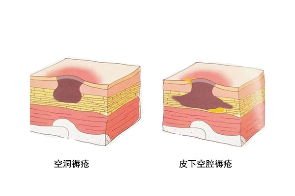 褥疮结黑痂怎么办?褥疮结痂并不等于愈合!_刘宁_副主任医师_爱问健康