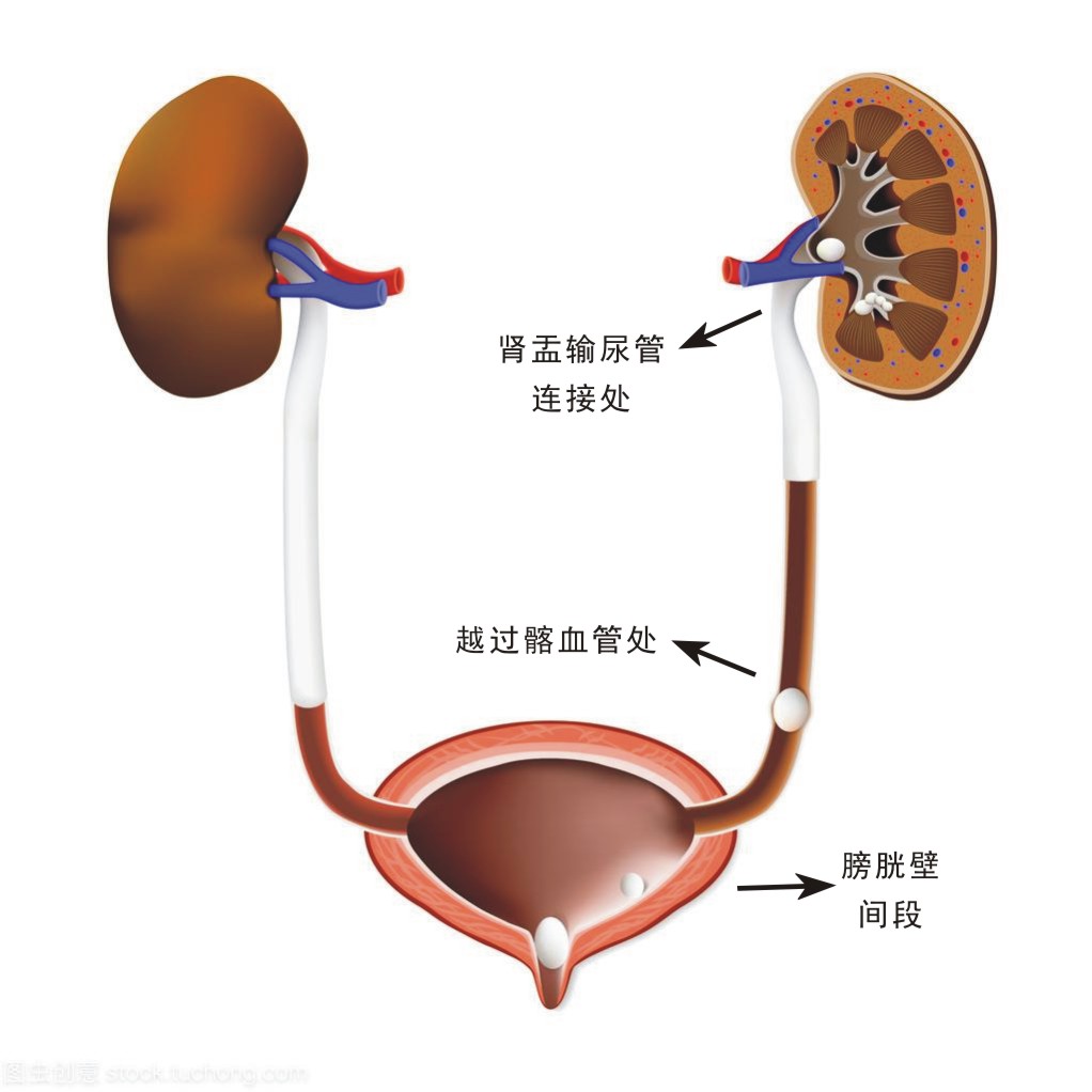 【肾结石】为什么肾结石有时疼,有时不疼?_王鑫_主任医师_爱问健康