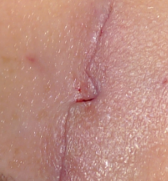 皮下缝合用什么线常用的疤痕切除术切口减张技术_https://www.jmylbn.com_新闻资讯_第3张