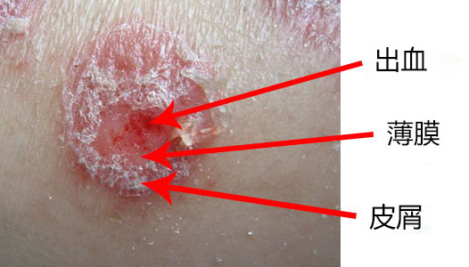 牛皮癣是一种怎样的疾病?