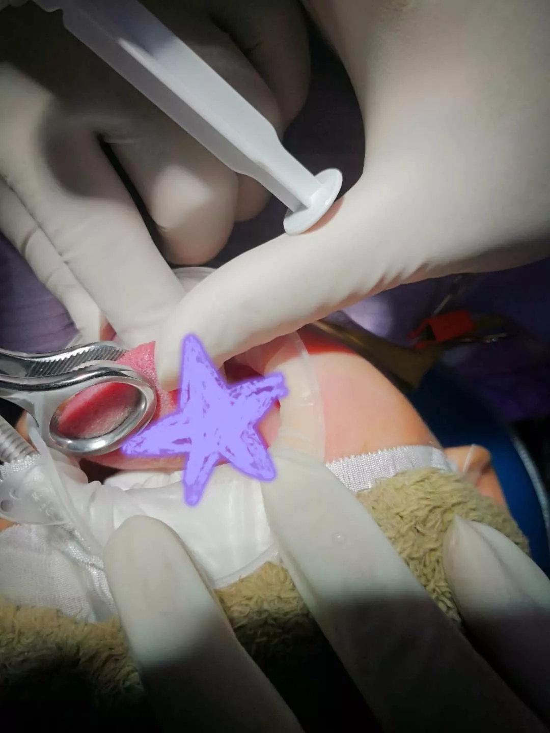 儿童口腔医院袁林天教授立刻为孩子进行详细口内检查发现孩子一半舌头