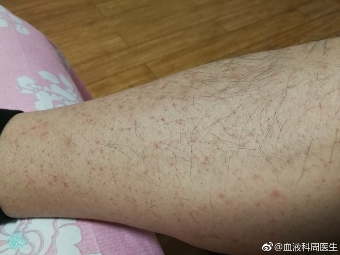 血液科医生患了过敏性紫癜