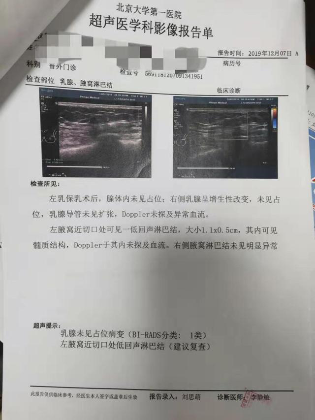 乳腺癌术后左侧腋窝出现淋巴结,组方调理三月后结节消失!