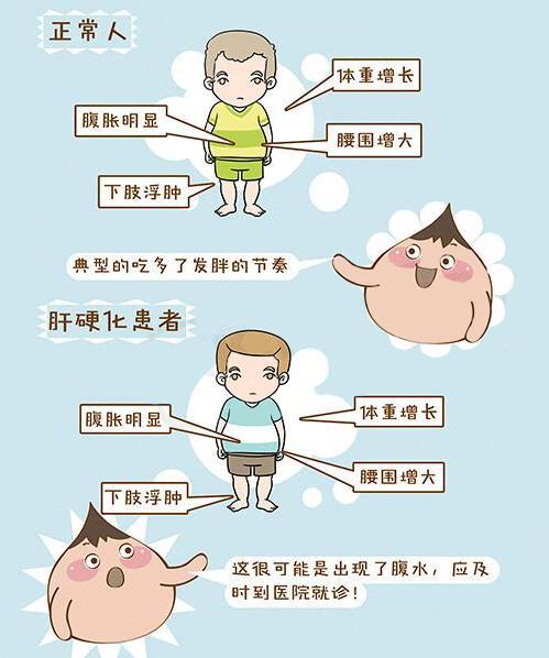 正确认识肝硬化,避免养肝误区