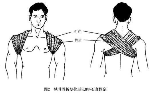 锁骨骨折多久恢复正常，怎样判断是否愈合？