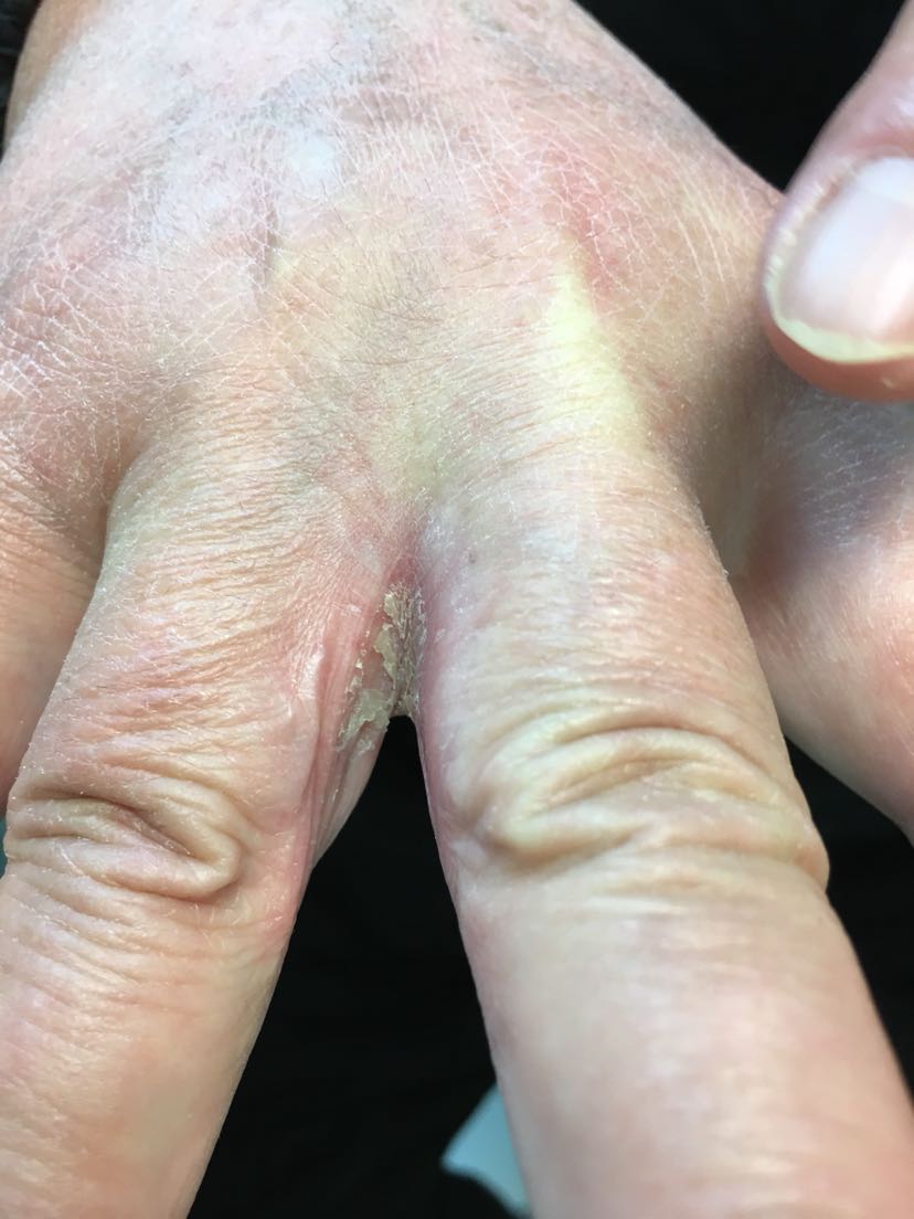 手指间因为沾水多,或者出汗多引起的,继发真菌