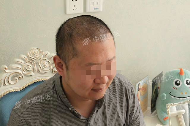 光头植发失败(植发后光头怎么上班)