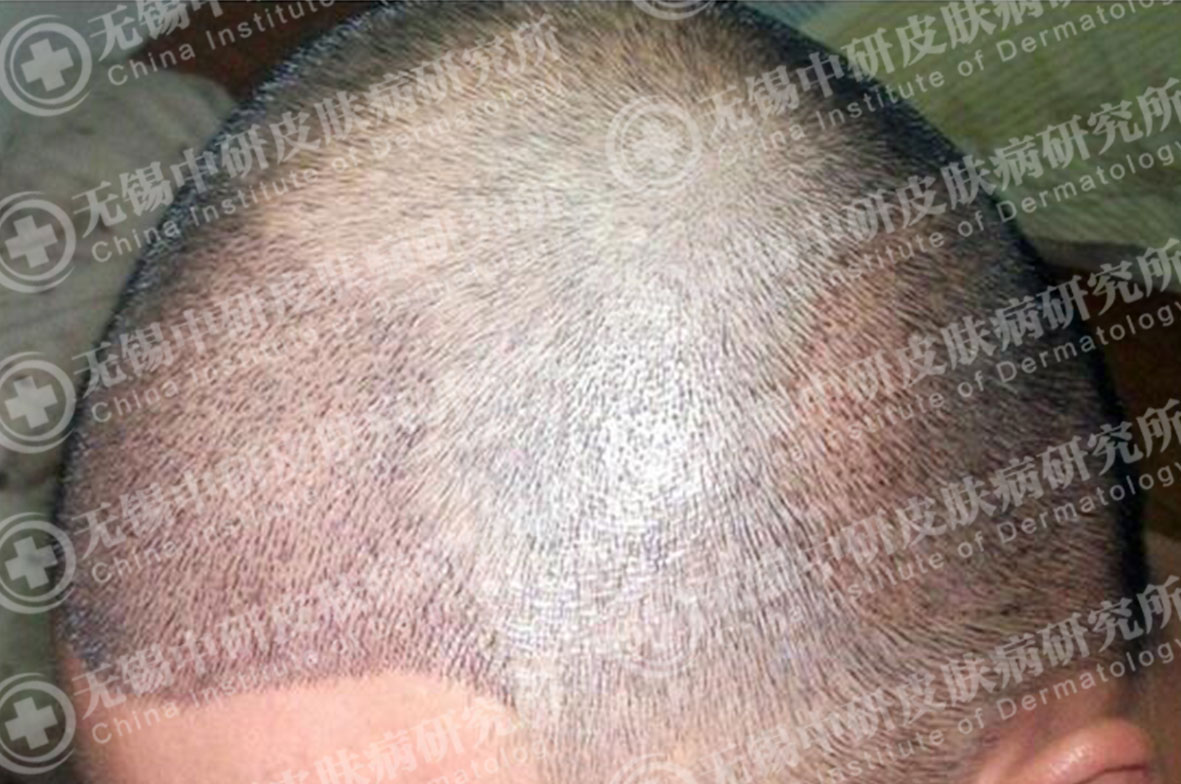真人植发案例：植发一周效果_罗正元__爱问健康