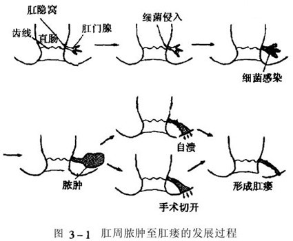 婴儿肛周脓肿:一个让父母心力交瘁的小病