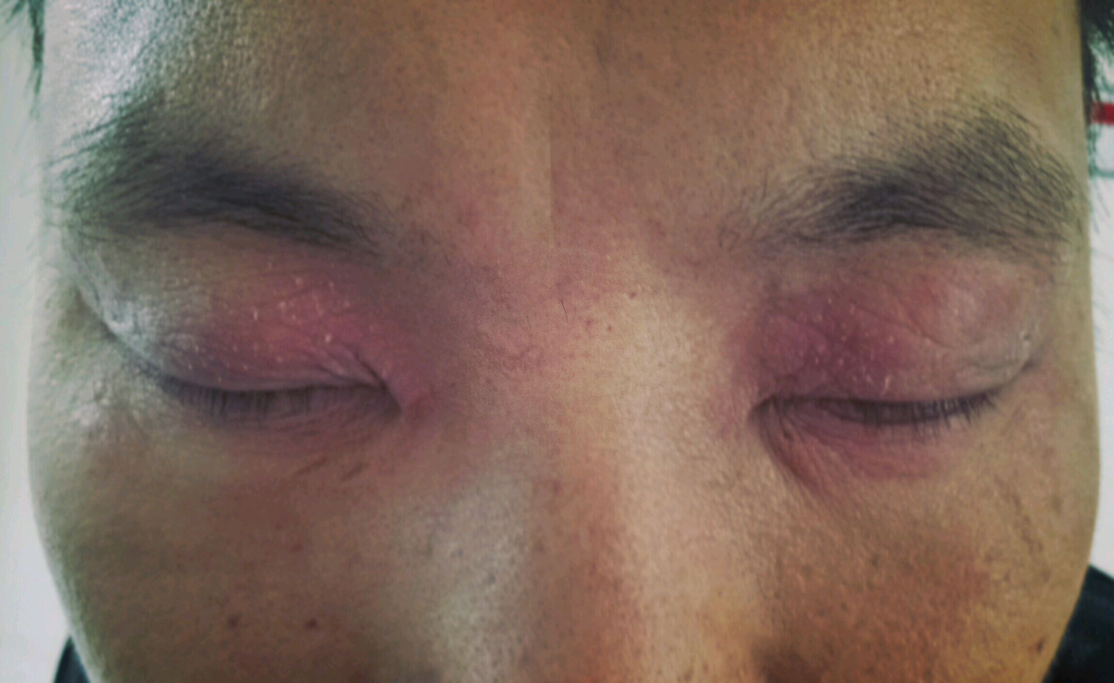 别人黑眼圈,而我是红眼圈,红鼻子,又剧痒,是什么病?