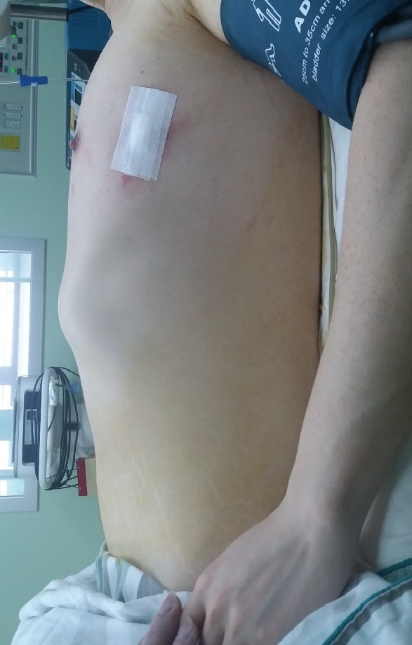 5,桶状胸患者,成年男性,骨质坚硬,前胸壁整体凸起,胸廓外观呈桶状