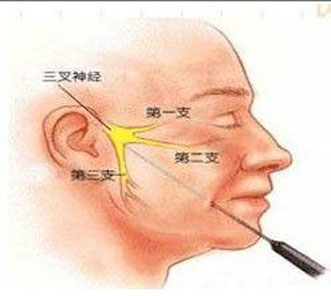 射频热凝治疗三叉神经痛