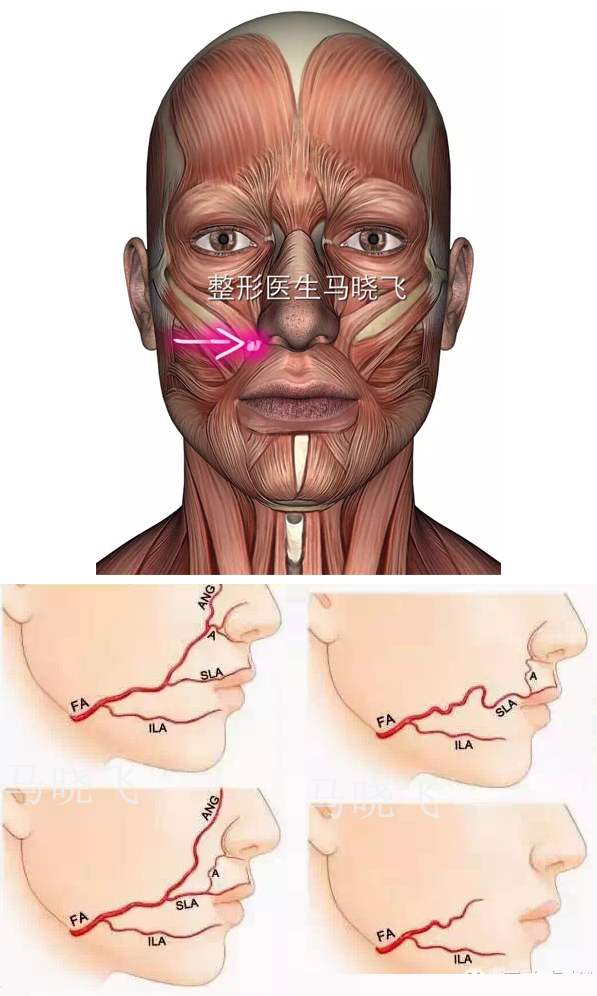 而这一区域最危险的地方在于血管,我们的面动脉就走行在鼻唇沟内,非常